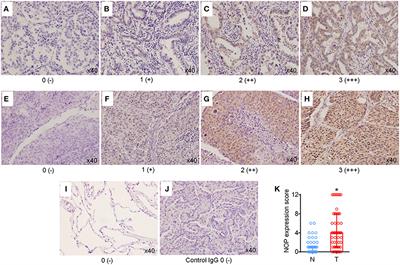 Nociceptin Receptor Is Overexpressed in Non-small Cell Lung Cancer and Predicts Poor Prognosis